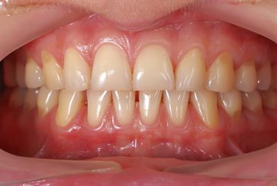 Coenzyme Q10 for gum disease
