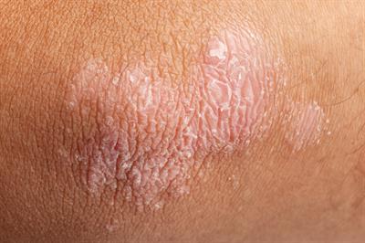 Pycnogenol® Found to Improve Psoriasis Symptoms