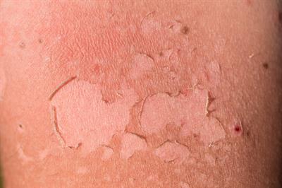 Pycnogenol® helps prevent UV damage and ageing