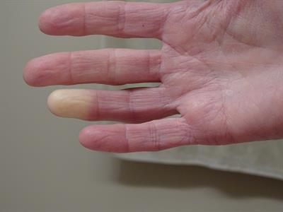 Suffer from Reynauds? These supplements may help